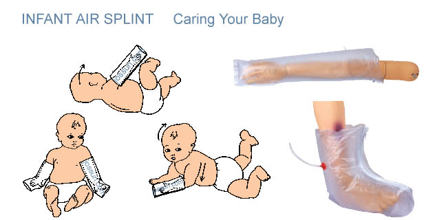 Infant splint2.jpg