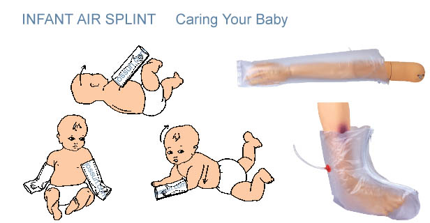 Infant splint2.jpg